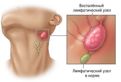 Увеличены лимфоузлы на шее: в чем причины и всегда ли нужно их лечить